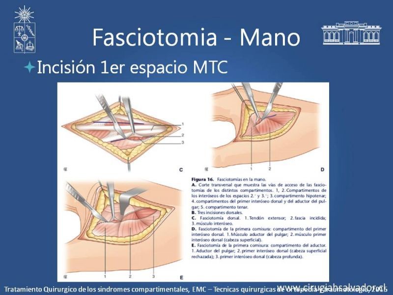 Diapositiva 34 de Síndrome Compartimental de Extremidades