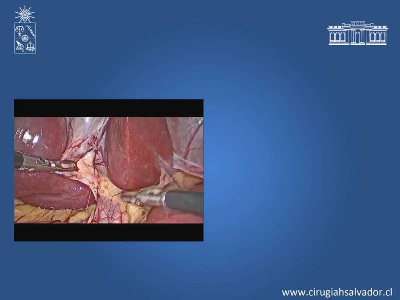 Diapositiva 9 de Colecsitectomía Segura
