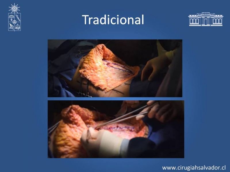 Diapositiva 15 de Lipectomía Abdominal