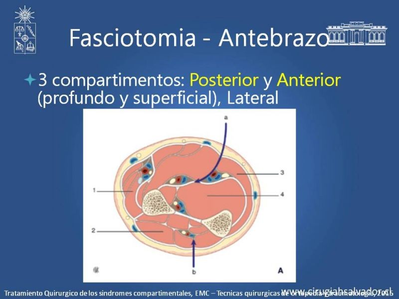 Diapositiva 26 de Síndrome Compartimental de Extremidades