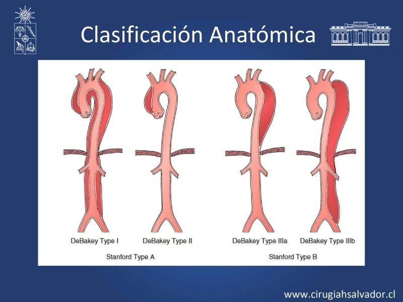 Diapositiva 7 de Síndrome Aórtico Agudo 