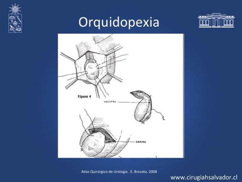 Diapositiva 13 de Tratamiento y pronóstico torsión testicular 
