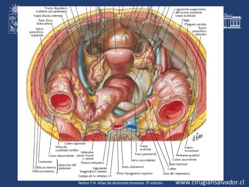 Diapositiva 4 de Lesiones iatrogénicas del sistema urinario en la cirugía colorrectal
