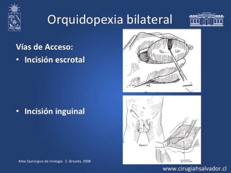 Diapositiva 11 de Tratamiento y pronóstico torsión testicular 