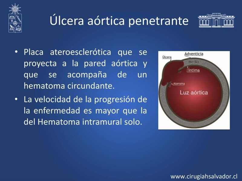 Diapositiva 4 de Síndrome Aórtico Agudo 