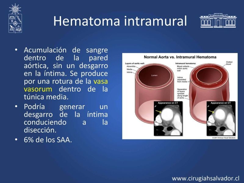 Diapositiva 5 de Síndrome Aórtico Agudo 