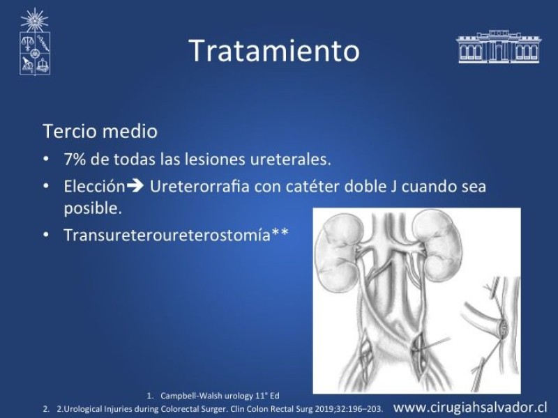 Diapositiva 12 de Lesiones iatrogénicas del sistema urinario en la cirugía colorrectal