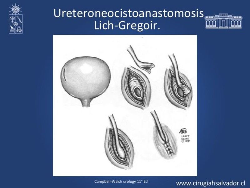 Diapositiva 14 de Lesiones iatrogénicas del sistema urinario en la cirugía colorrectal