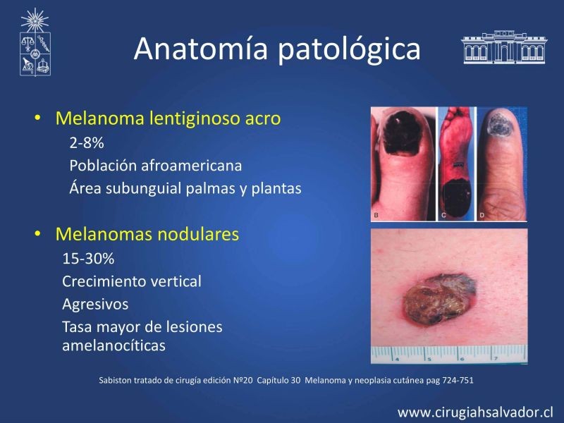 Diapositiva 13 de Melanoma: enfrentamiento inicial