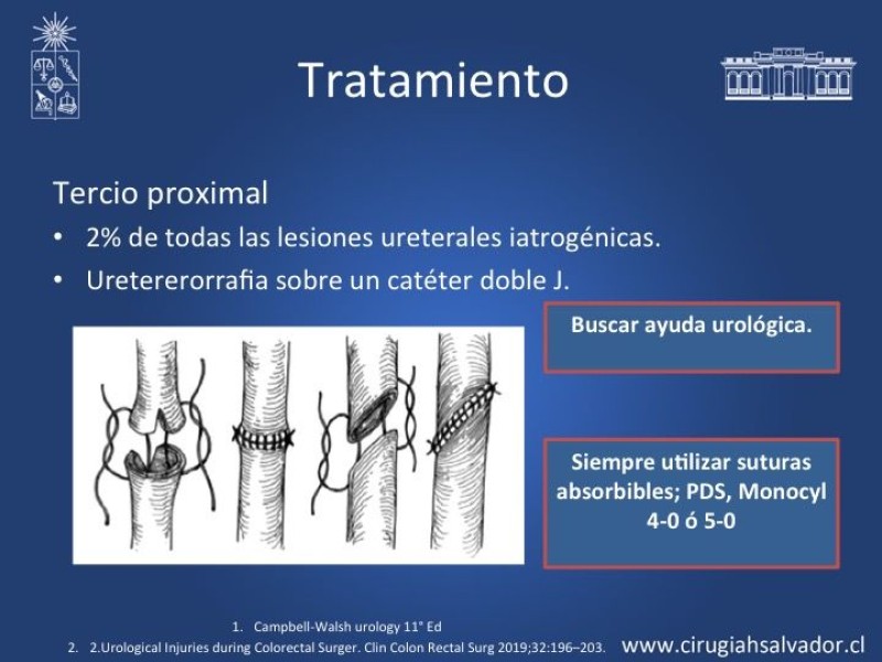 Diapositiva 11 de Lesiones iatrogénicas del sistema urinario en la cirugía colorrectal