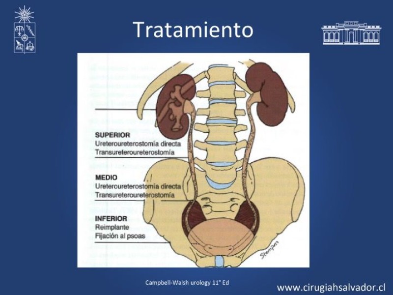 Diapositiva 16 de Lesiones iatrogénicas del sistema urinario en la cirugía colorrectal