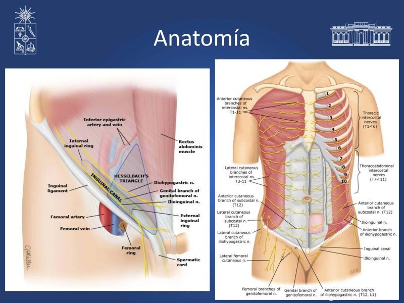 Diapositiva 5 de Inguinodinia post hernioplastía inguinal