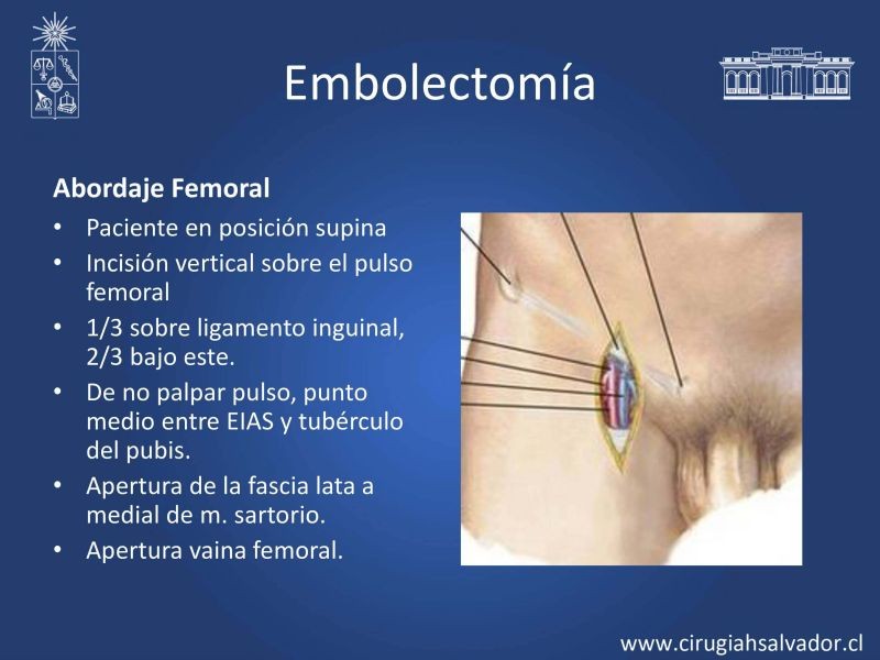 Diapositiva 18 de Isquemia aguda de extremidades inferiores