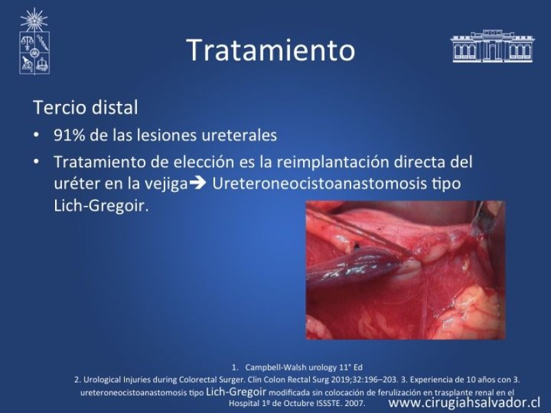 Diapositiva 13 de Lesiones iatrogénicas del sistema urinario en la cirugía colorrectal