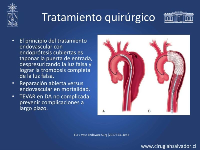 Diapositiva 18 de Síndrome Aórtico Agudo 