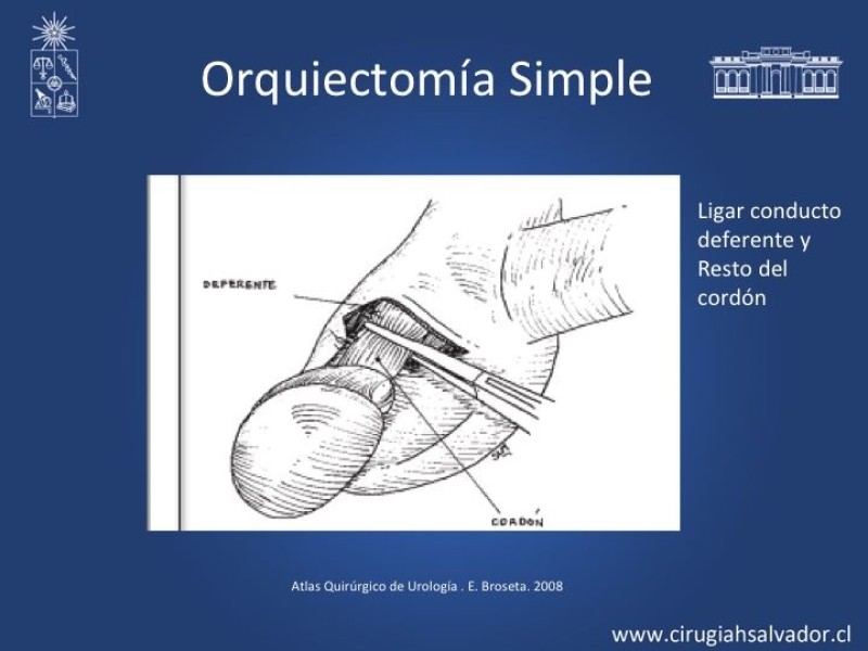 Diapositiva 14 de Tratamiento y pronóstico torsión testicular 