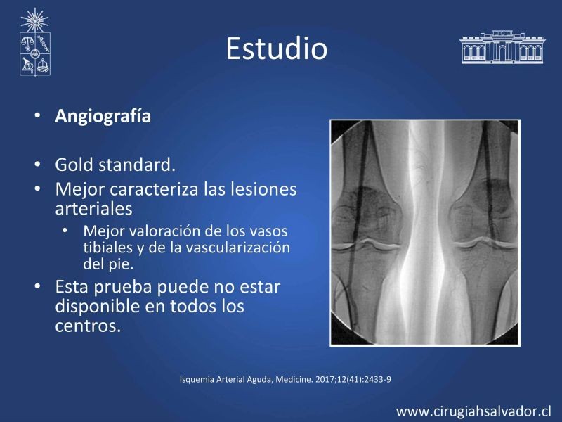 Diapositiva 13 de Isquemia aguda de extremidades inferiores