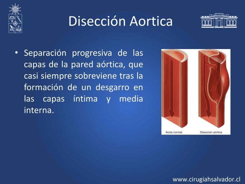Diapositiva 3 de Síndrome Aórtico Agudo 