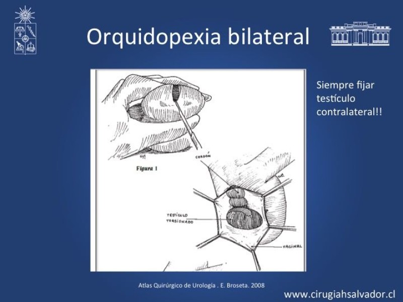 Diapositiva 12 de Tratamiento y pronóstico torsión testicular 