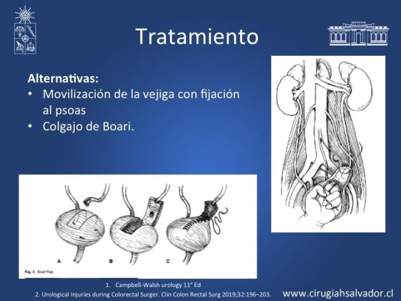 Diapositiva 15 de Lesiones iatrogénicas del sistema urinario en la cirugía colorrectal