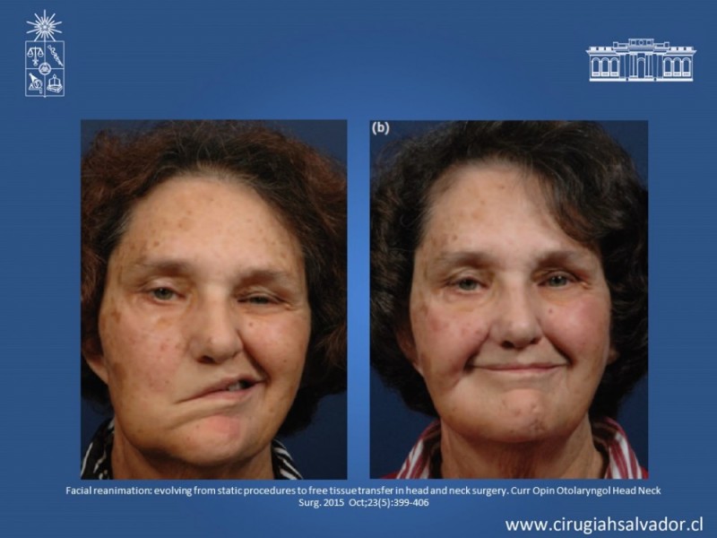 Diapositiva 21 de Reanimación Facial