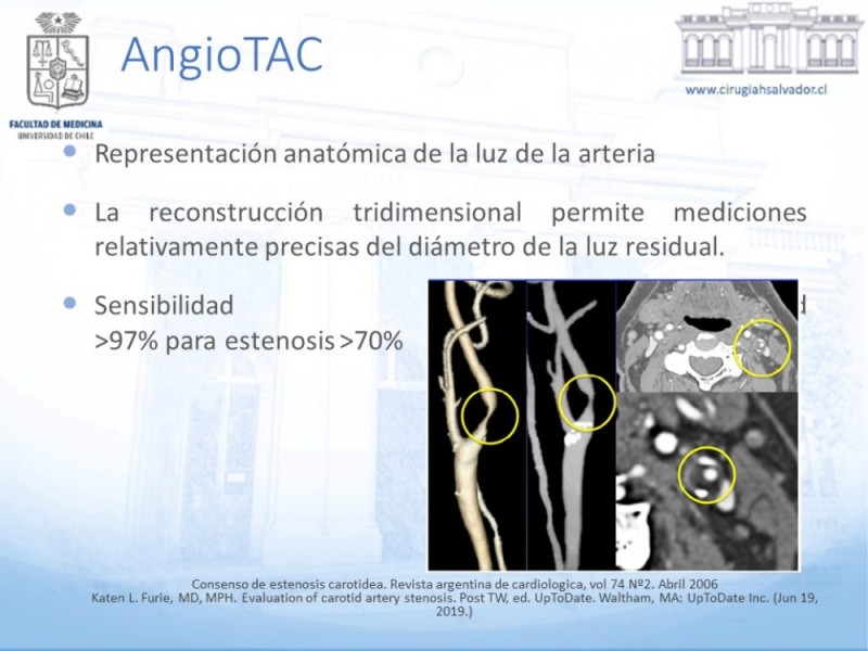 Diapositiva 15 de Enfermedad carotídea sintomática