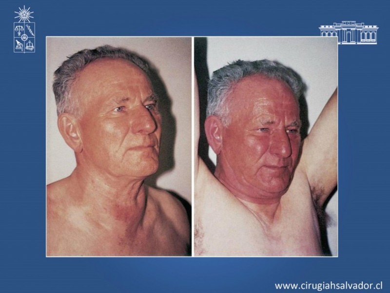 Diapositiva 9 de Bocio intratorácico
