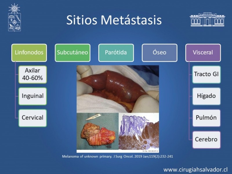 Diapositiva 15 de Melanoma Metastásico sin Primario Conocido