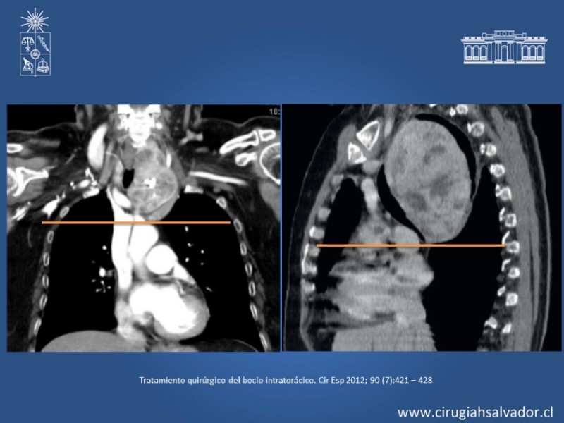 Diapositiva 11 de Bocio intratorácico