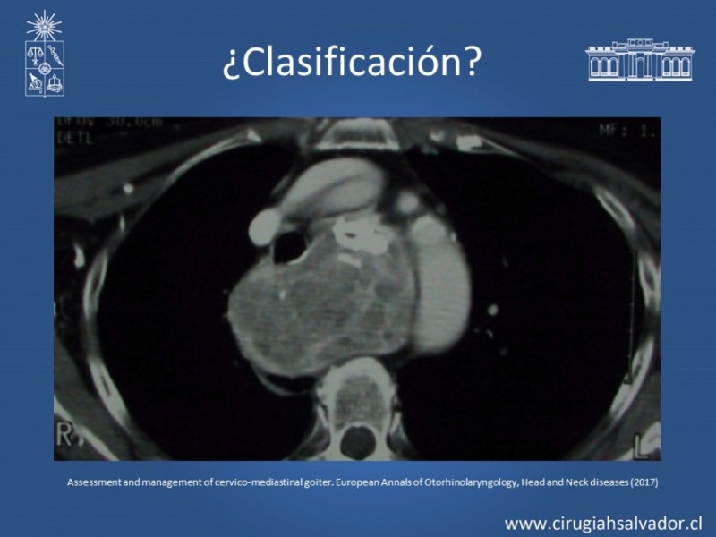 Diapositiva 14 de Bocio intratorácico