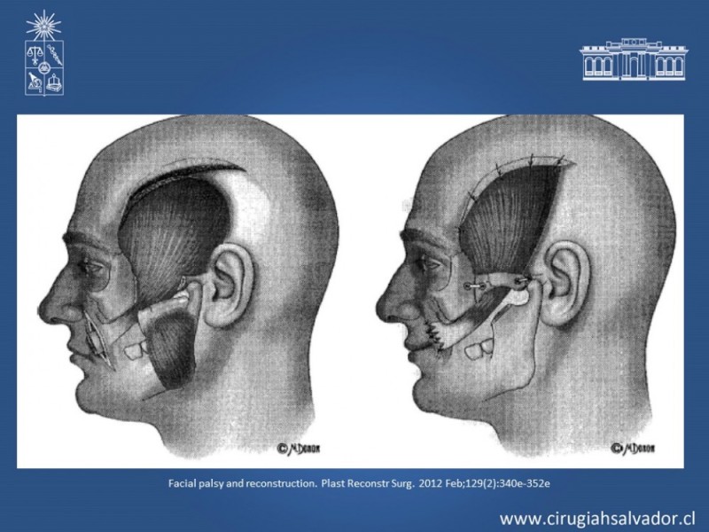 Diapositiva 20 de Reanimación Facial