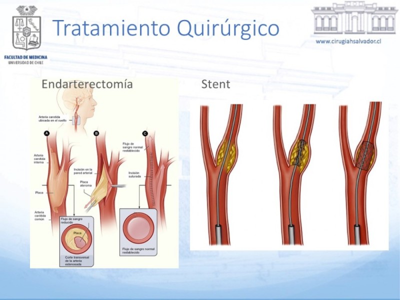Diapositiva 22 de Enfermedad carotídea sintomática