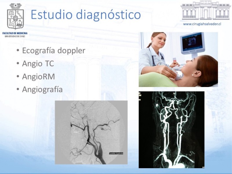 Diapositiva 10 de Enfermedad carotídea sintomática