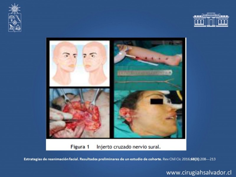 Diapositiva 18 de Reanimación Facial