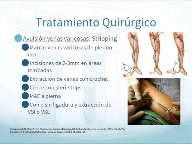 Diapositiva 21 de Insuficiencia Venosa Crónica