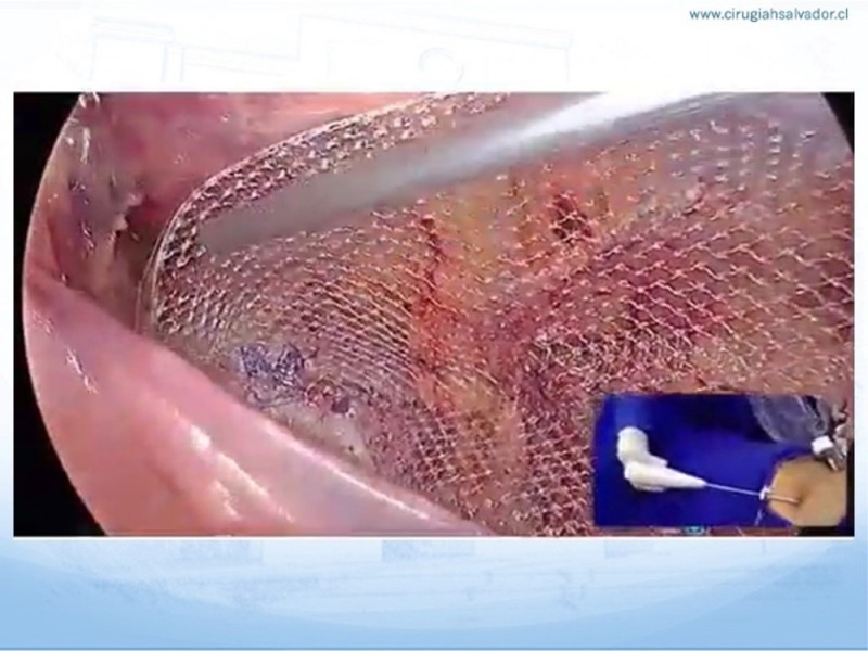 Diapositiva 24 de Hernia Inguinal: Hitos Anatómicos para cirugía laparoscópica-3