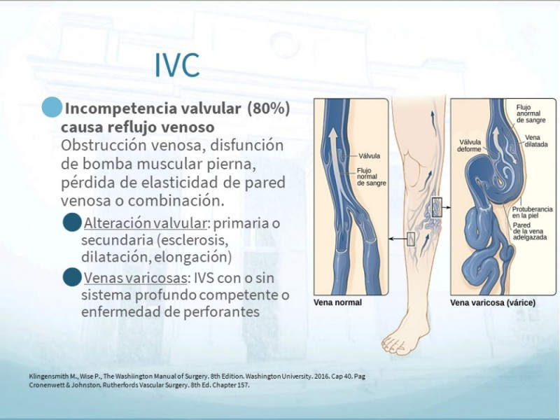 Diapositiva 3 de Insuficiencia Venosa Crónica