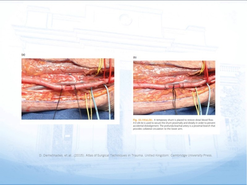 Diapositiva 20 de Control de lesión vascular para el cirujano general