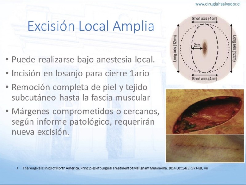 Diapositiva 10 de Manejo Quirúrgico del Melanoma