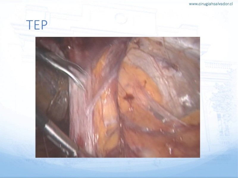 Diapositiva 31 de Hernia Inguinal: Hitos Anatómicos para cirugía laparoscópica-3