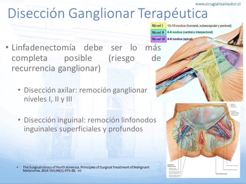 Diapositiva 18 de Manejo Quirúrgico del Melanoma