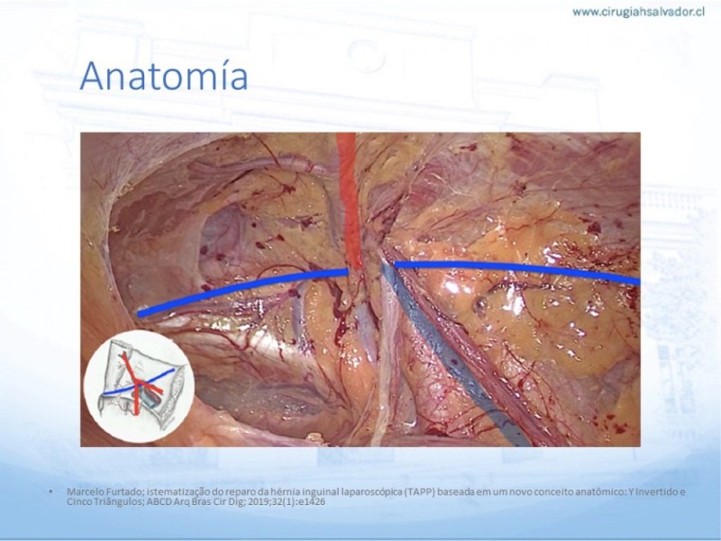 Diapositiva 13 de Hernia Inguinal: Hitos Anatómicos para cirugía laparoscópica-3
