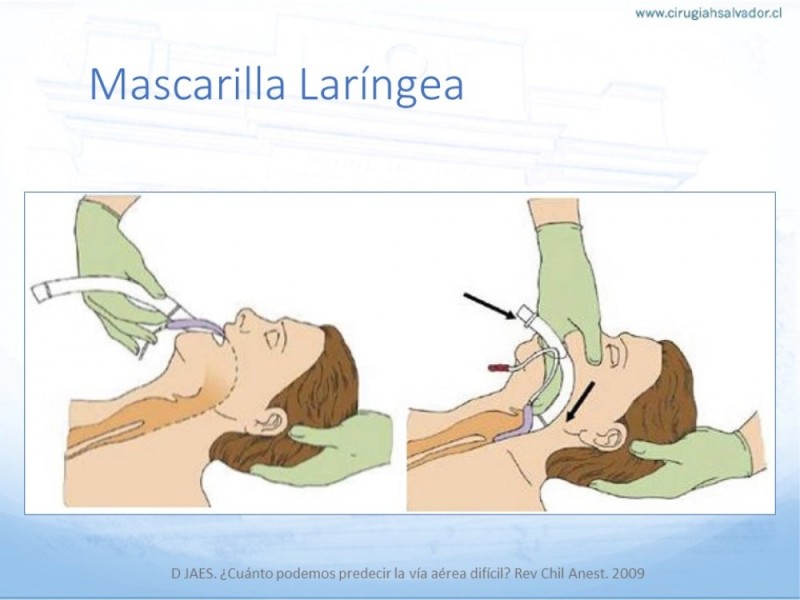 Diapositiva 25 de Manejo de Vía Aérea. Evaluación, Dispositivos y Algoritmos DAS