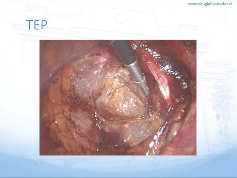 Diapositiva 30 de Hernia Inguinal: Hitos Anatómicos para cirugía laparoscópica-3
