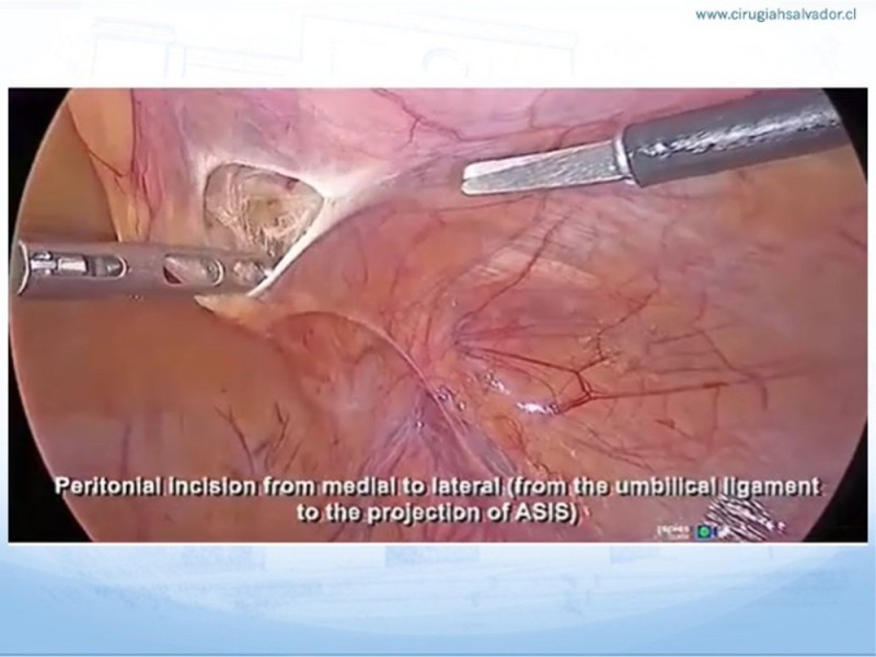 Diapositiva 20 de Hernia Inguinal: Hitos Anatómicos para cirugía laparoscópica-3