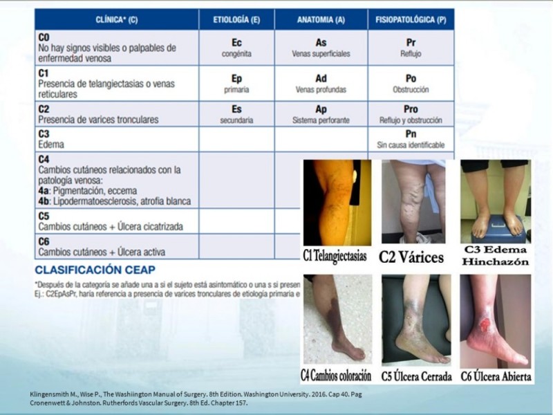 Diapositiva 6 de Insuficiencia Venosa Crónica