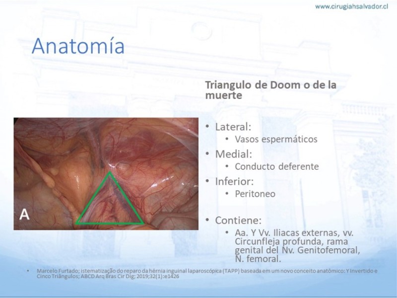Diapositiva 10 de Hernia Inguinal: Hitos Anatómicos para cirugía laparoscópica-3