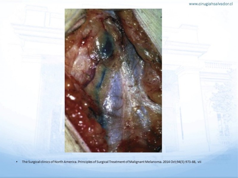 Diapositiva 15 de Manejo Quirúrgico del Melanoma