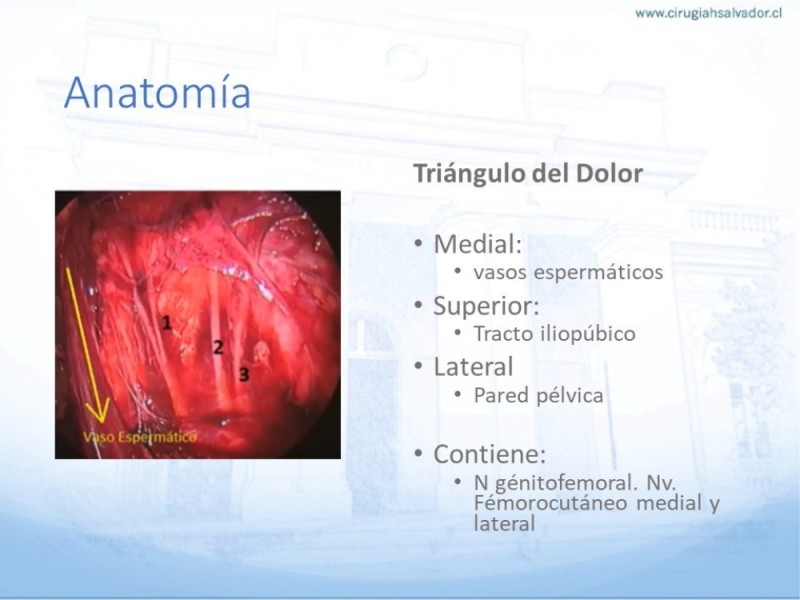Diapositiva 11 de Hernia Inguinal: Hitos Anatómicos para cirugía laparoscópica-3