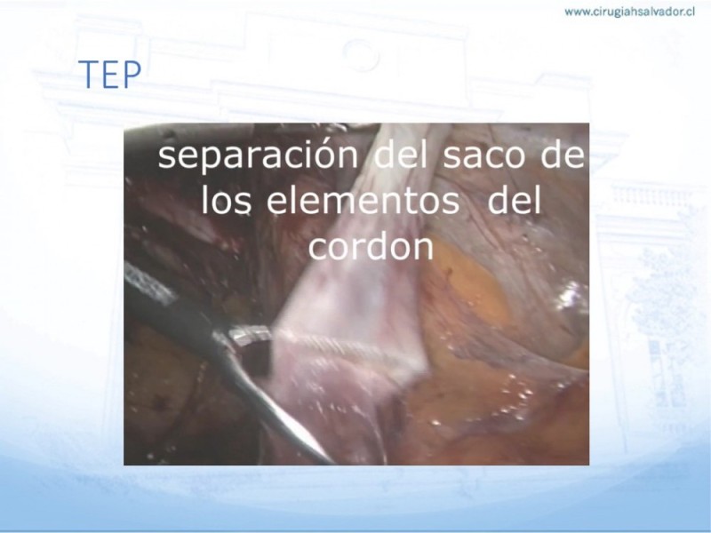Diapositiva 32 de Hernia Inguinal: Hitos Anatómicos para cirugía laparoscópica-3